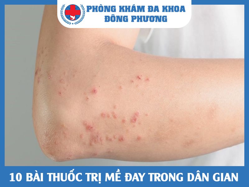 10 bài thuốc trị mề đay trong dân gian