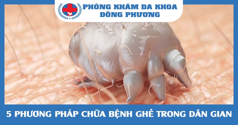 5 phương pháp chữa bệnh ghẻ hữu hiệu nhất trong dân gian