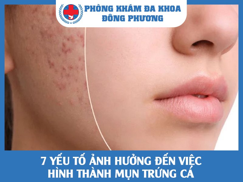 7 yếu tố ảnh hưởng đến việc hình thành mụn trứng cá