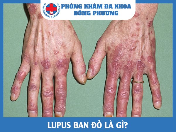 Tất tần tật về bệnh lupus ban đỏ