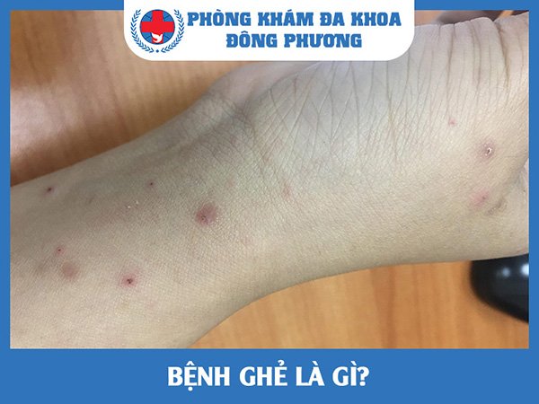 Bệnh ghẻ là gì?