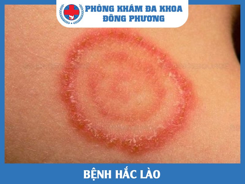 Bệnh hắc lào