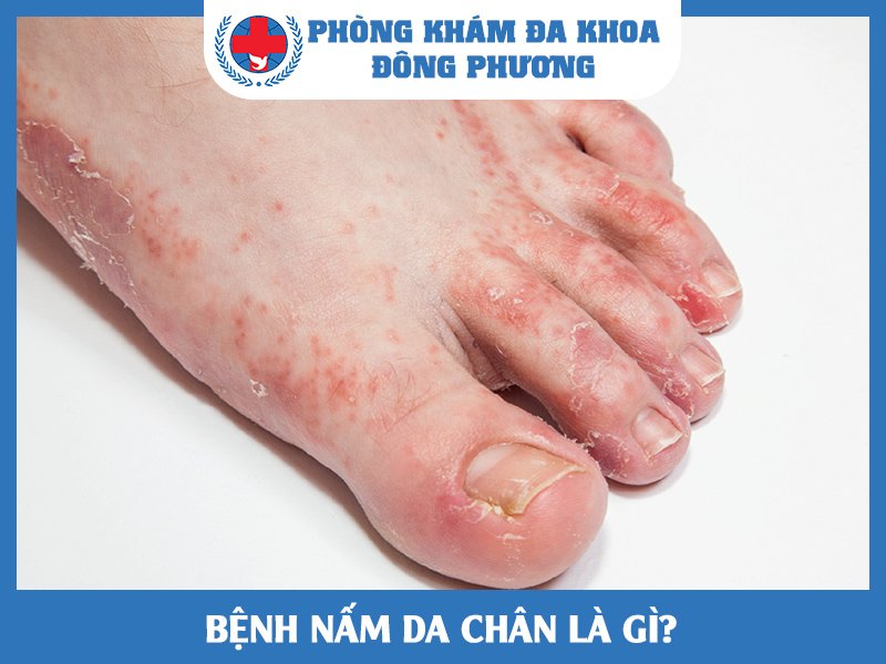 Nên làm gì khi bị nấm da chân?