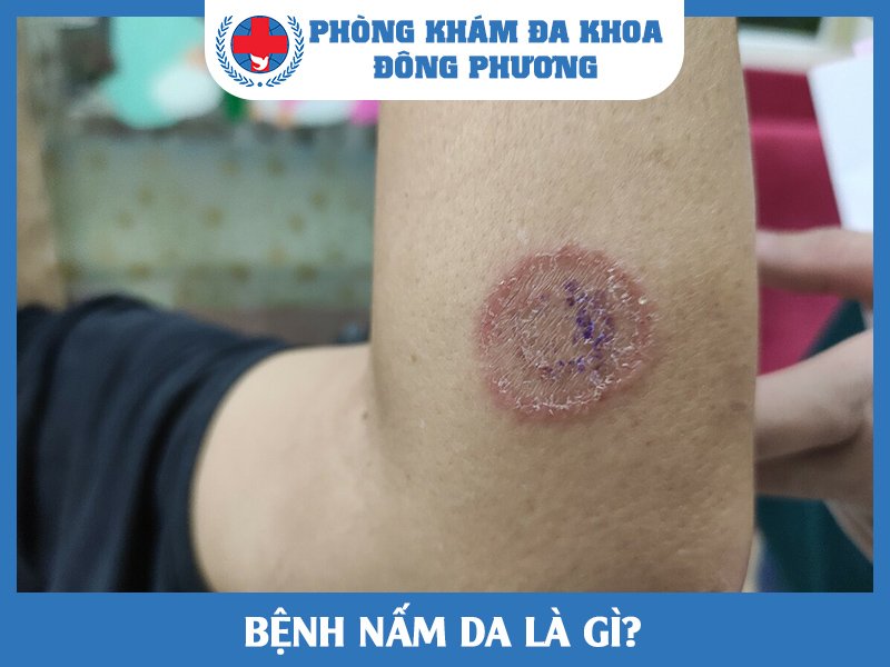 Bệnh nấm da là gì