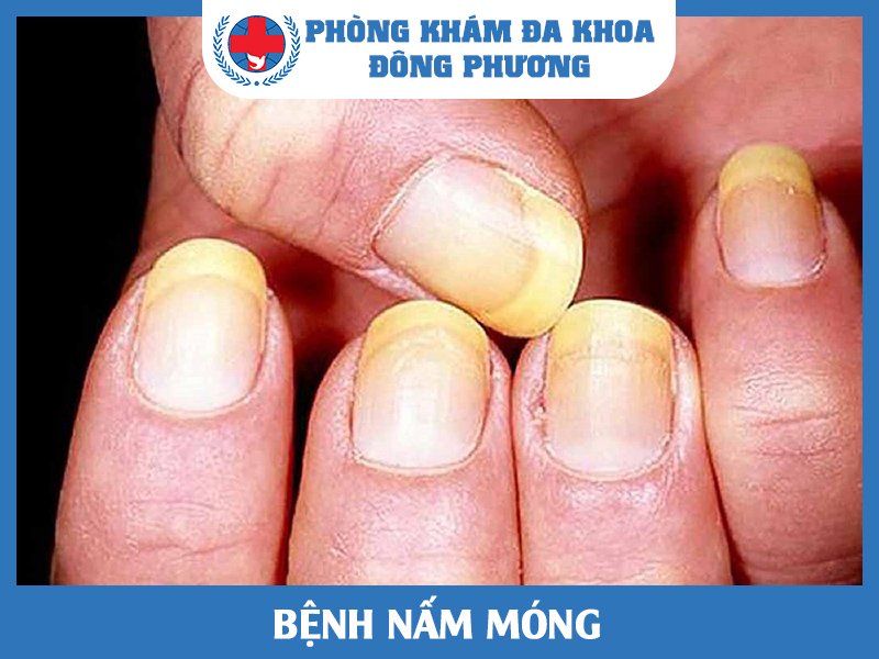 Nấm móng