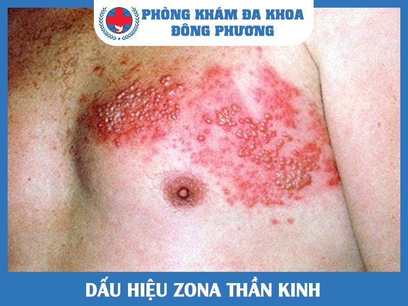 Dấu hiệu bệnh zona