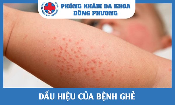 Dấu hiệu của bệnh ghẻ