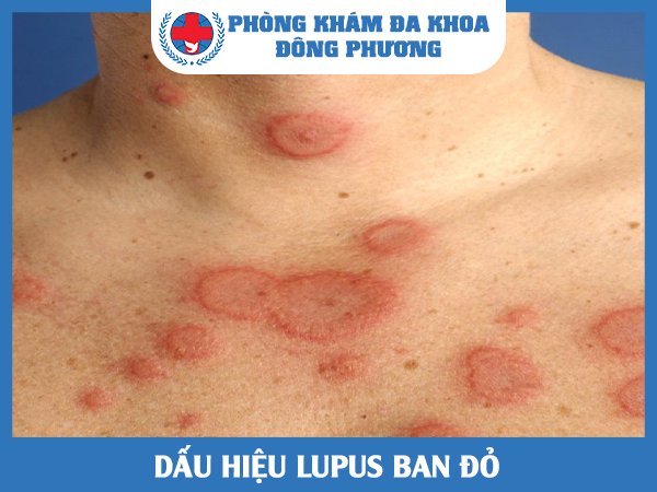 Dấu hiệu Lupus ban đỏ