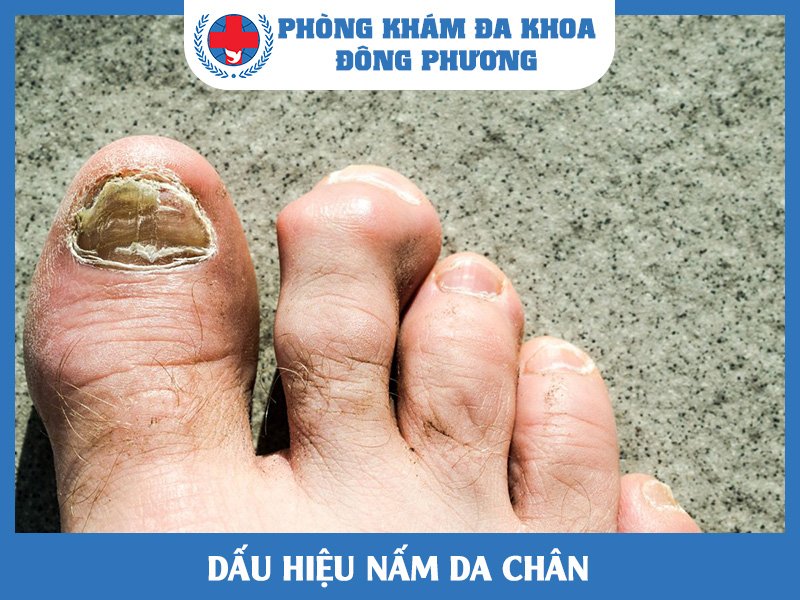 Biểu hiện của nấm da chân