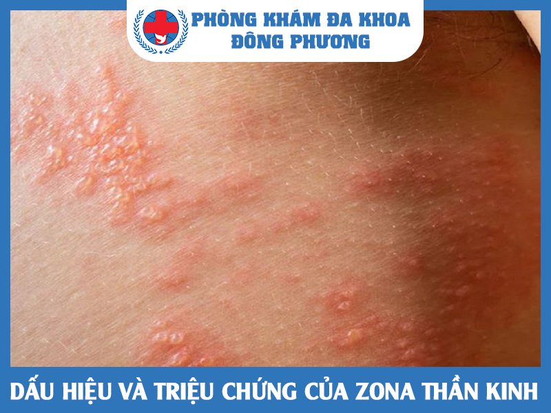 Zona thần kinh: Dấu hiệu và nguyên nhân gây bệnh