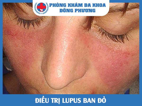 Điều trị Lupus ban đỏ