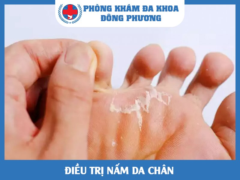 Điều trị nấm da chân