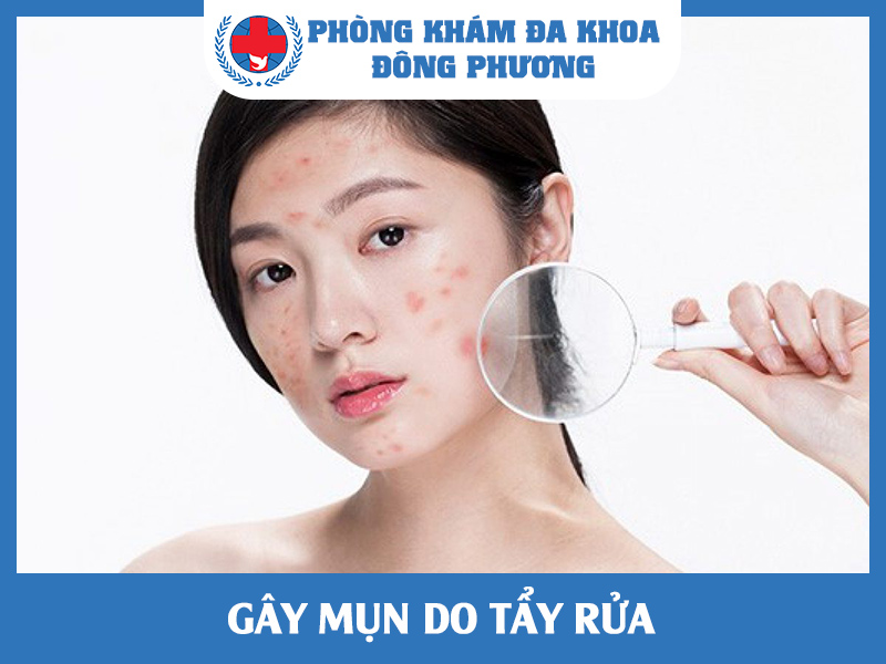 Gây mụn do tẩy rửa