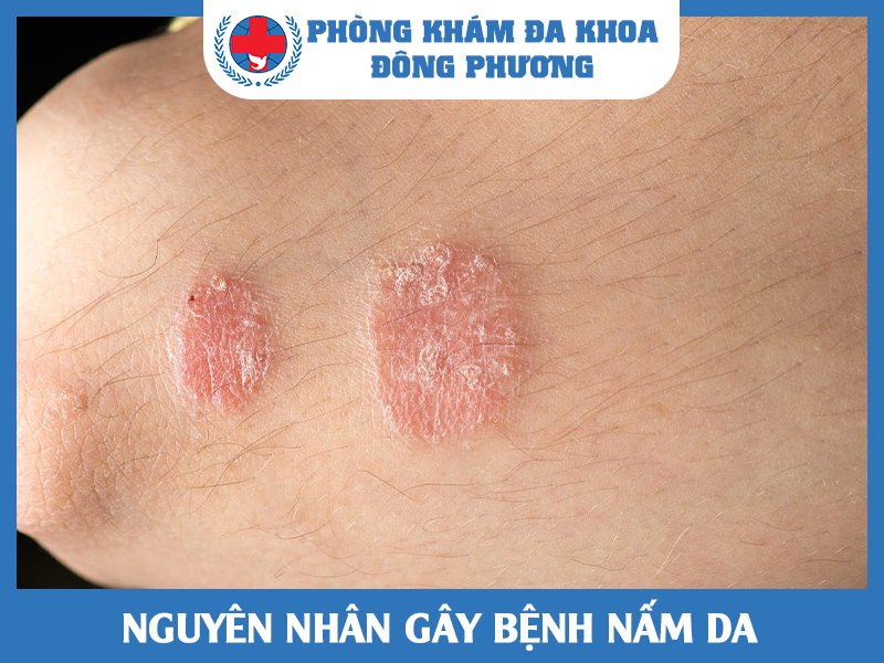 Nguyên nhân gây bệnh nấm da