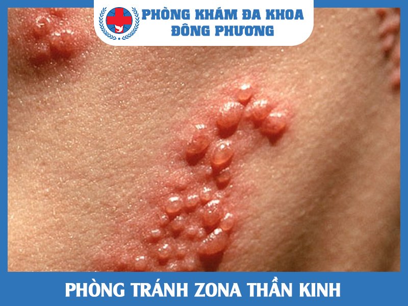 Phòng tránh Zona thần kinh