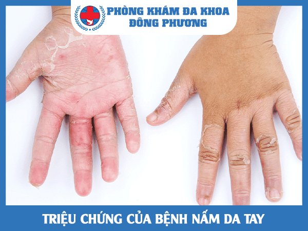 Triệu chứng của bệnh nấm da tay