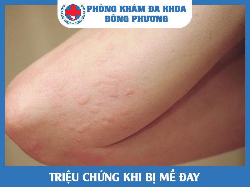 Triệu chứng khi bị mề đay