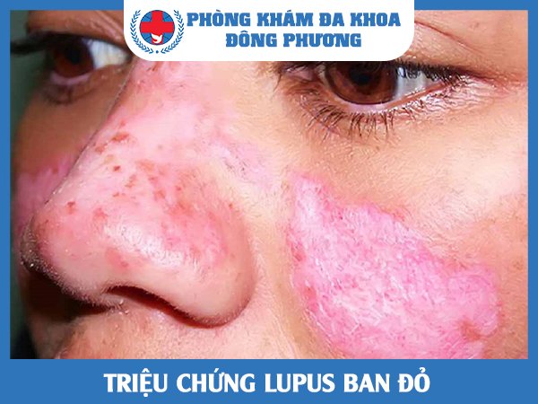 Triệu chứng của Lupus ban đỏ