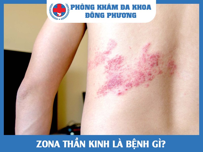 zona thần kinh là gi?