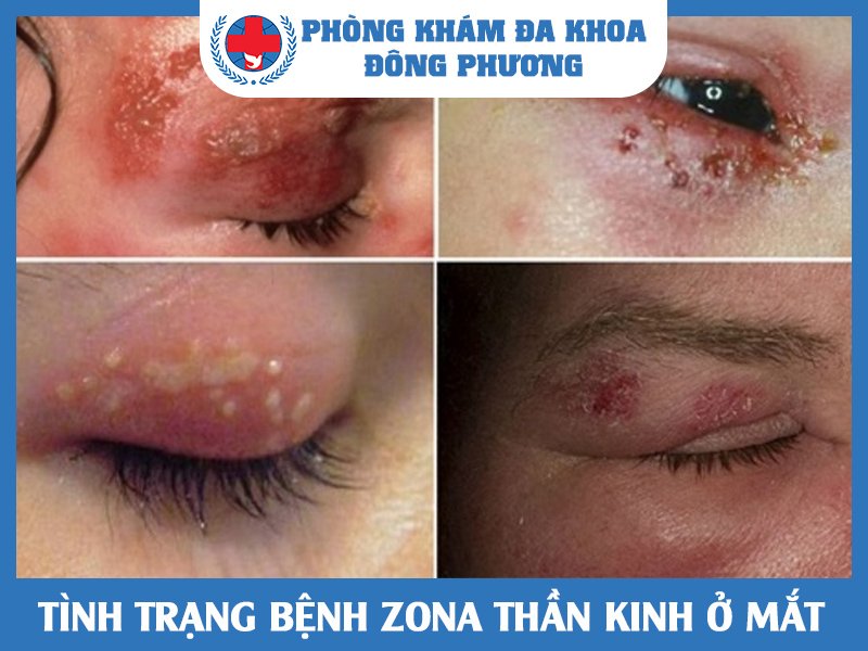 Tình trạng zona ở mắt