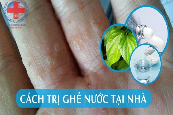 Mách Bạn Những Cách Trị Ghẻ Nước Tại Nhà