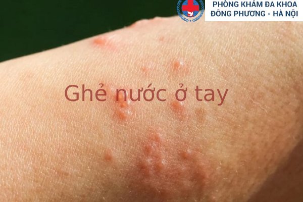 Ghẻ Nước Ở Tay Và Hiểm Họa Tiềm Ẩn Cho Sức Khỏe