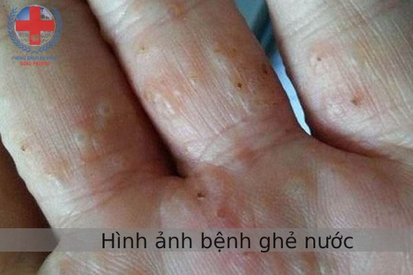 Hình Ảnh Bệnh Ghẻ Nước: Cách Nhận Biết Và Phòng Tránh Hiệu Quả