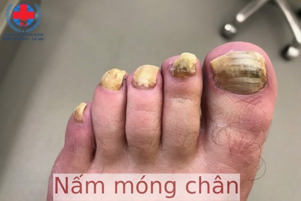 Nấm Móng Chân: Nguy Cơ Và Cách Phòng Tránh