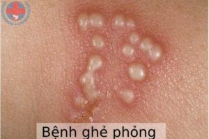 benh-ghe-phong-01