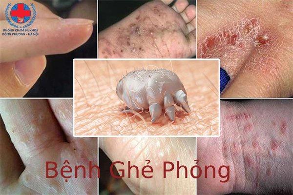 Bệnh Ghẻ Phỏng: Những Biểu Hiện Và Cách Phòng Tránh